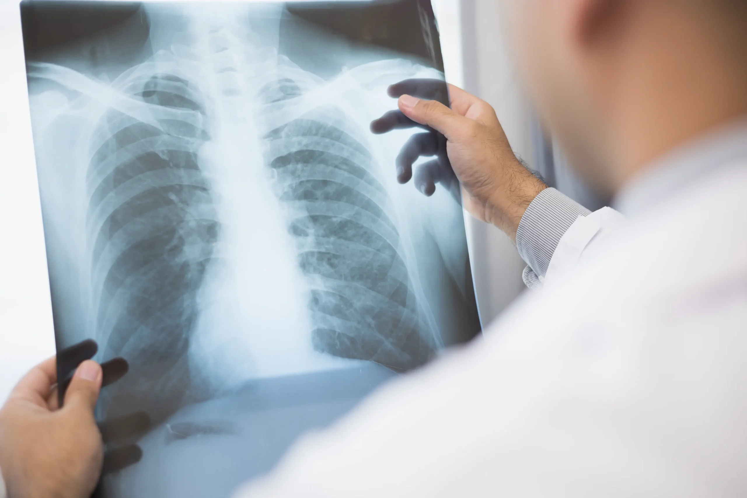 Doctor examining a chest X-ray, showing diagnostic imaging as part of your first visit with the ImpactMD accident care team.